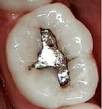 Amalgam